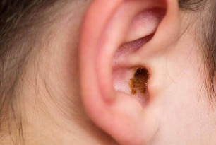 Earwax In Ear
