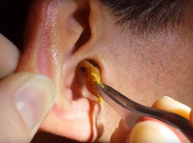 Earwax Being Removed